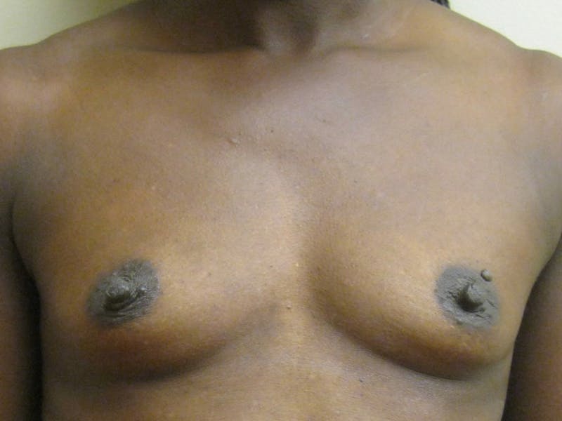 Breast Augmentation Before & After Gallery - Patient 87563991 - Image 3