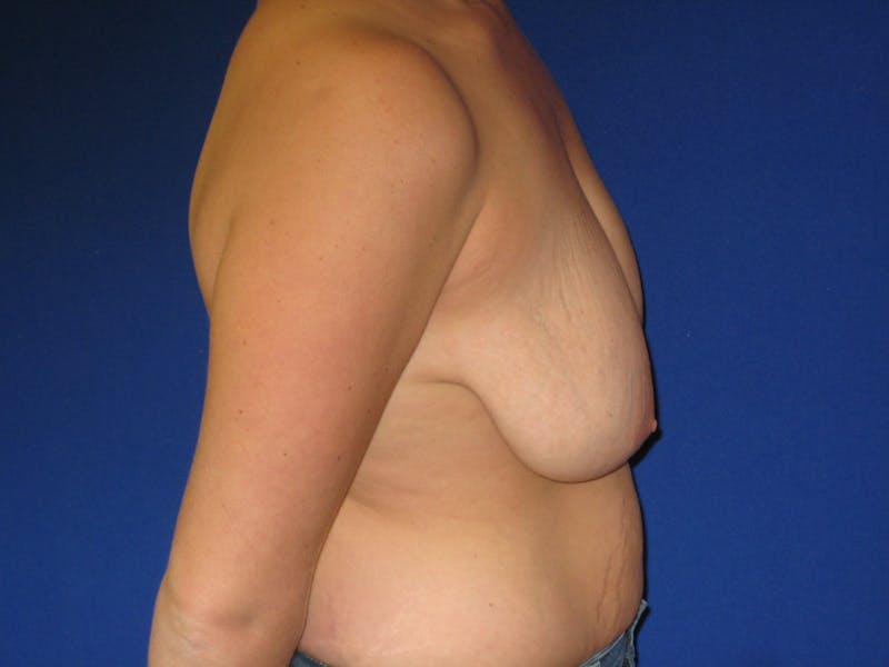 Breast Lift Before & After Gallery - Patient 87563990 - Image 3