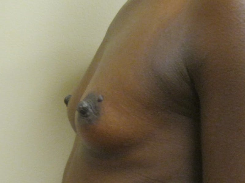 Breast Augmentation Before & After Gallery - Patient 87563991 - Image 5