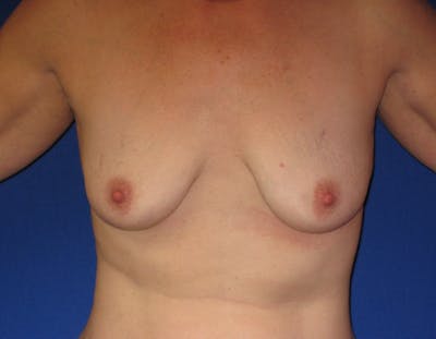 Breast Lift Before & After Gallery - Patient 87563993 - Image 1