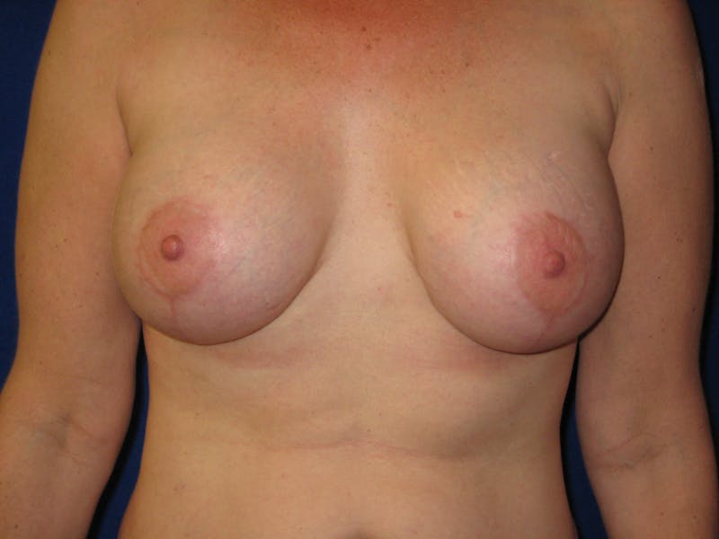 Breast Lift Before & After Gallery - Patient 87563993 - Image 2