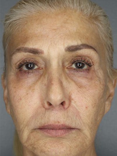 Filler Before & After Gallery - Patient 87563995 - Image 1