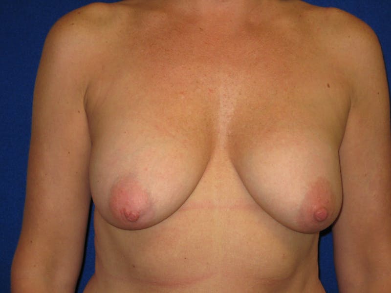 Breast Lift Before & After Gallery - Patient 87563996 - Image 1