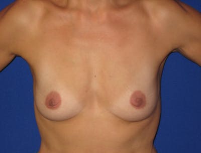 Breast Augmentation Before & After Gallery - Patient 87563998 - Image 1