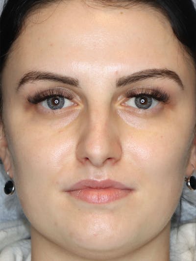 Filler Before & After Gallery - Patient 87563997 - Image 1
