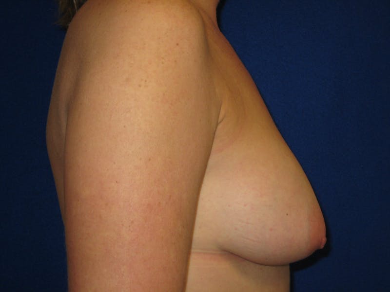 Breast Lift Before & After Gallery - Patient 87563996 - Image 3