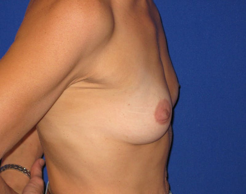 Breast Augmentation Before & After Gallery - Patient 87563998 - Image 3