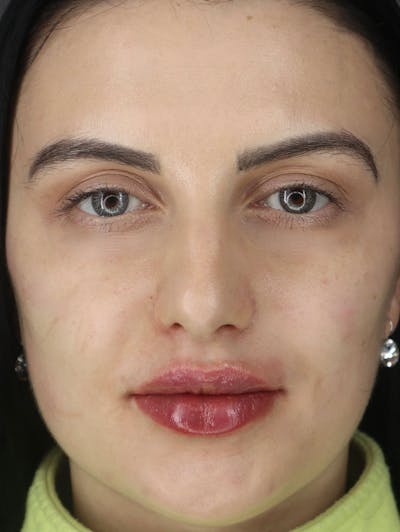Filler Before & After Gallery - Patient 87563997 - Image 2