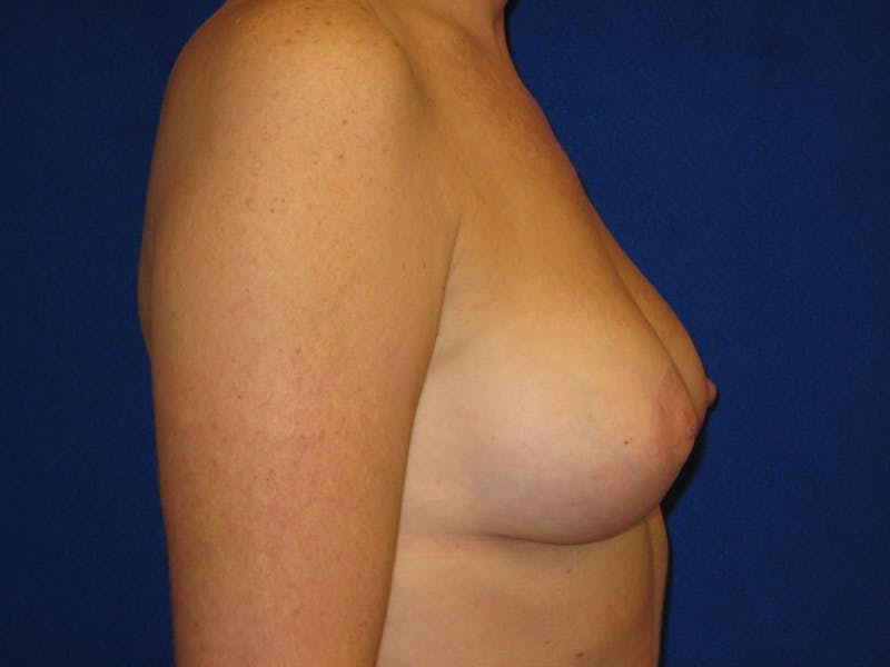 Breast Lift Before & After Gallery - Patient 87563996 - Image 4