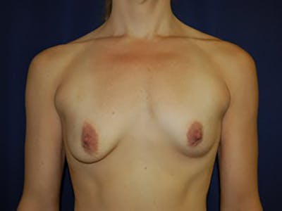 Breast Lift Before & After Gallery - Patient 87564003 - Image 1