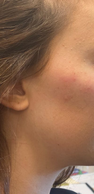 Filler Before & After Gallery - Patient 87563999 - Image 1