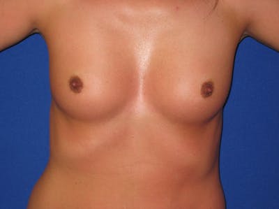 Breast Augmentation Before & After Gallery - Patient 87564004 - Image 1