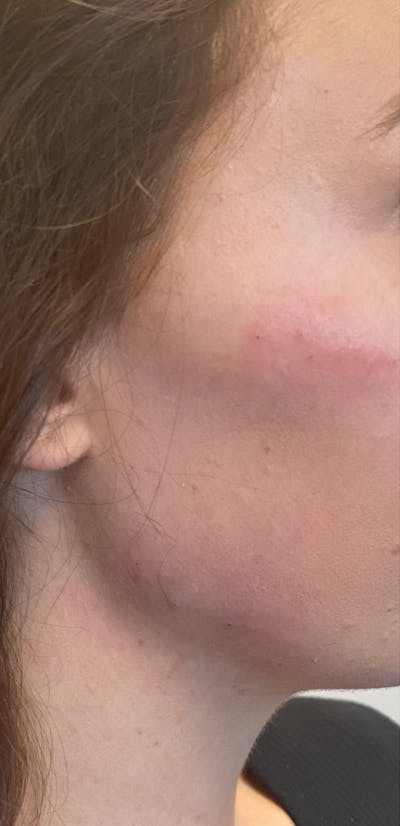 Filler Before & After Gallery - Patient 87563999 - Image 2