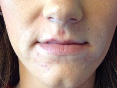 Filler Before & After Gallery - Patient 87564002 - Image 1