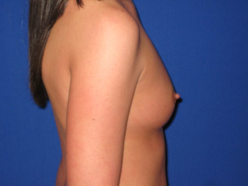 Breast Augmentation Before & After Gallery - Patient 87564004 - Image 3