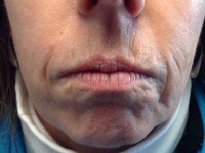 Filler Before & After Gallery - Patient 87564005 - Image 1
