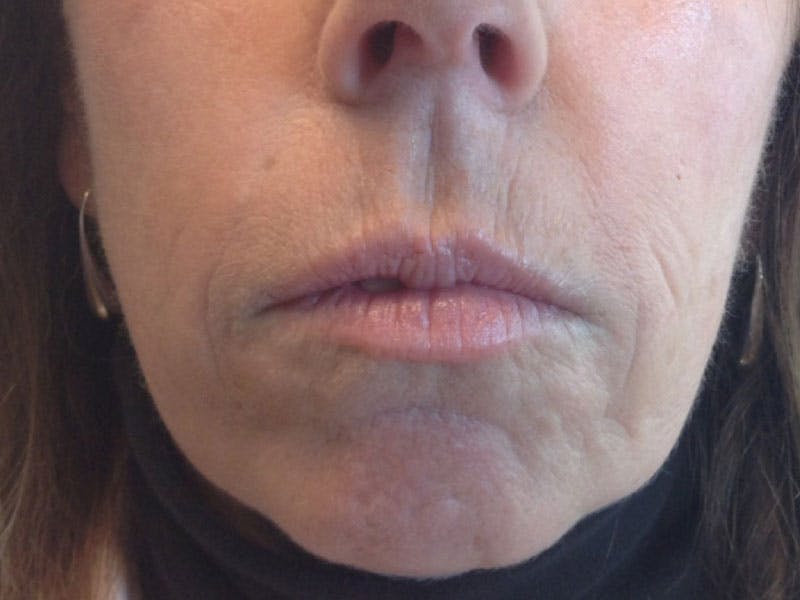Filler Before & After Gallery - Patient 87564005 - Image 2