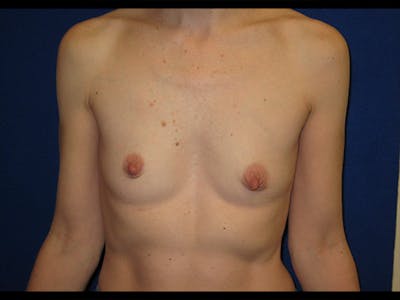 Breast Augmentation Before & After Gallery - Patient 87564006 - Image 1
