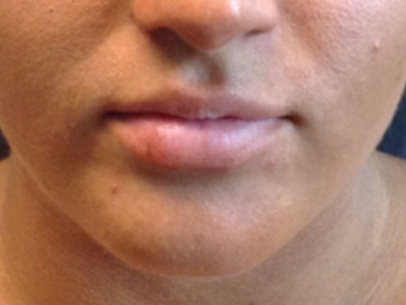 Filler Before & After Gallery - Patient 87564007 - Image 1