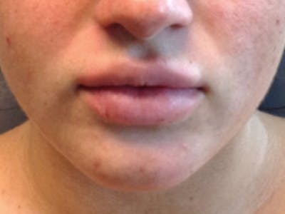 Filler Before & After Gallery - Patient 87564007 - Image 2