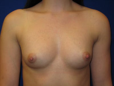 Breast Augmentation Before & After Gallery - Patient 87564009 - Image 1