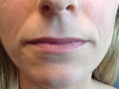 Filler Before & After Gallery - Patient 87564008 - Image 1