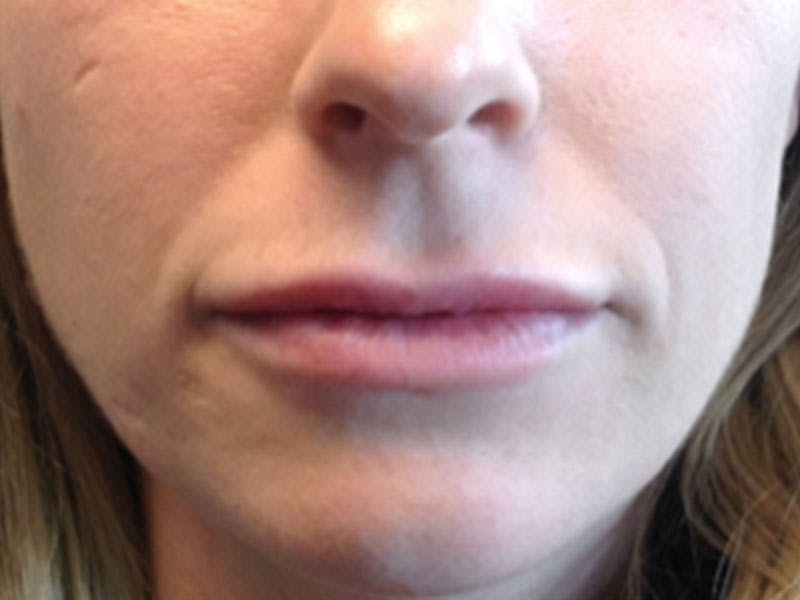 Filler Before & After Gallery - Patient 87564008 - Image 2