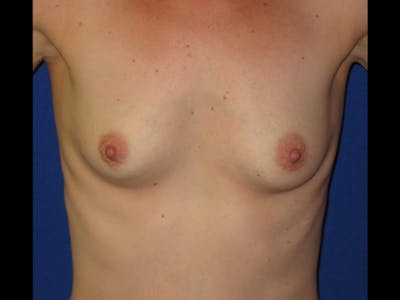 Breast Augmentation Before & After Gallery - Patient 87564013 - Image 1