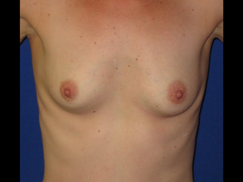 Breast Augmentation Before & After Gallery - Patient 87564013 - Image 1