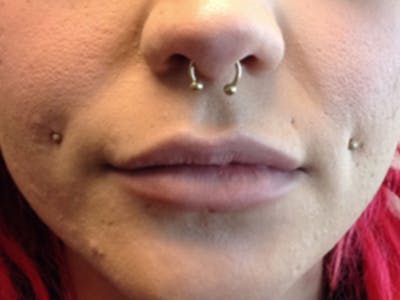 Filler Before & After Gallery - Patient 87564011 - Image 2