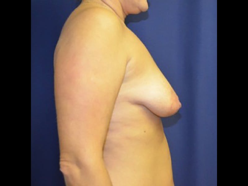 Breast Lift Before & After Gallery - Patient 87564015 - Image 1