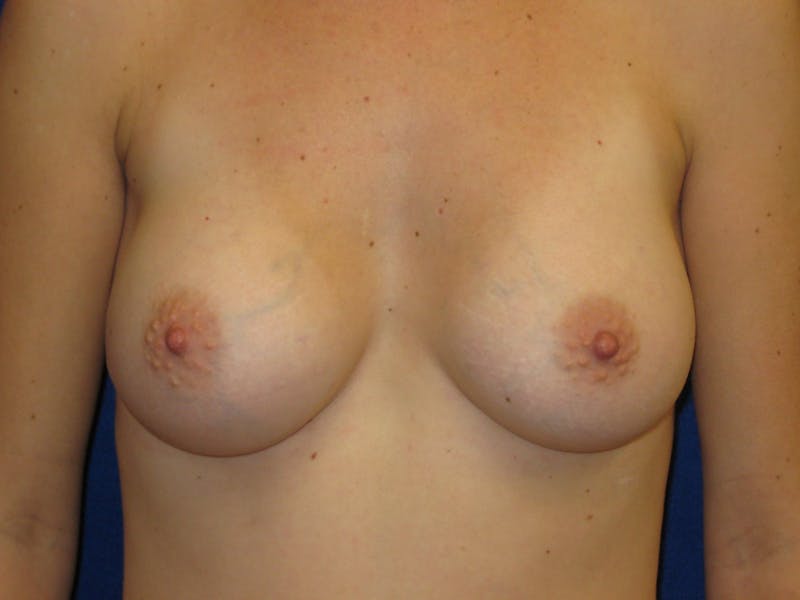 Breast Augmentation Before & After Gallery - Patient 87564013 - Image 2