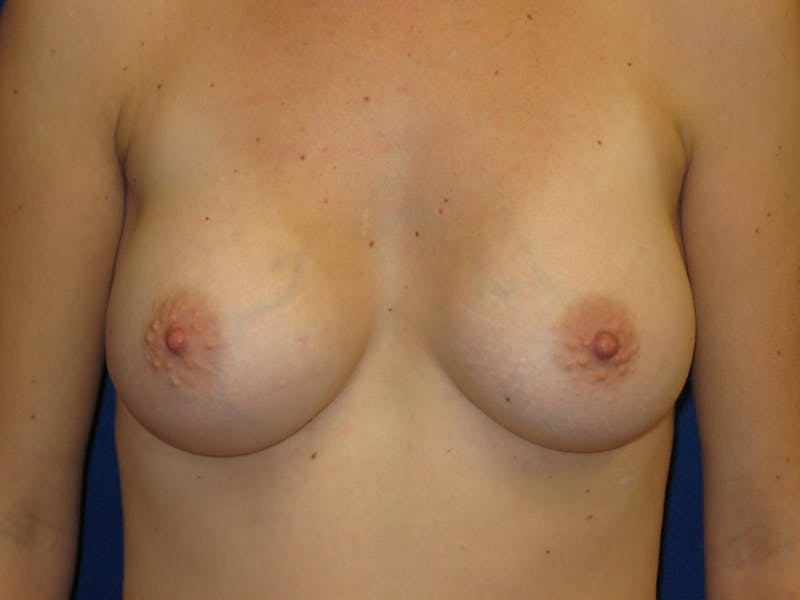 Breast Augmentation Before & After Gallery - Patient 87564013 - Image 2