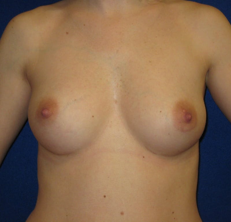Breast Augmentation Before & After Gallery - Patient 87564022 - Image 1