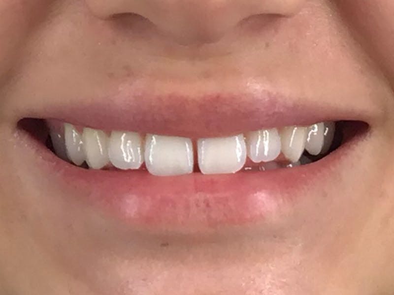 Filler Before & After Gallery - Patient 87564017 - Image 2