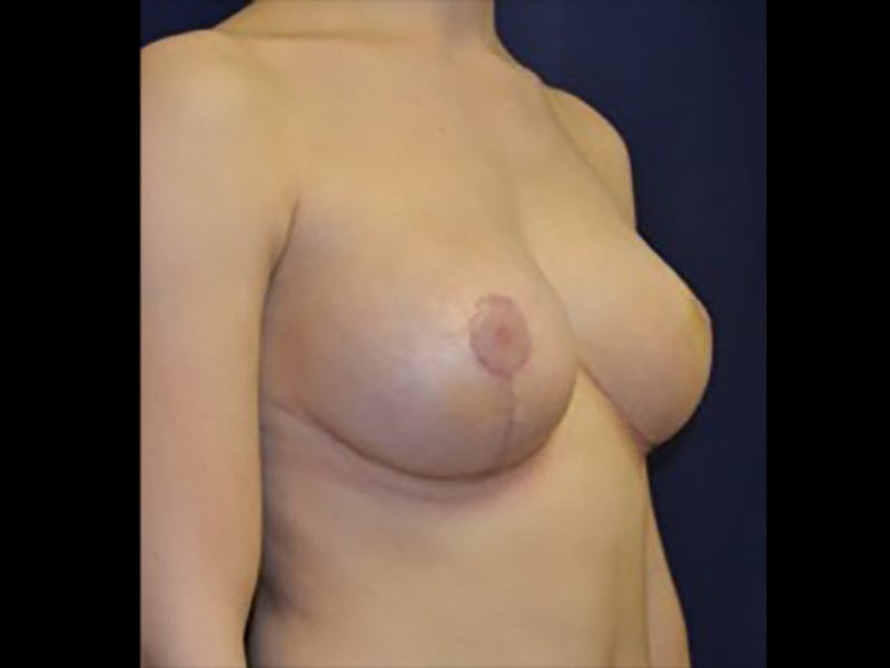 Breast Lift Before & After Gallery - Patient 87564025 - Image 4