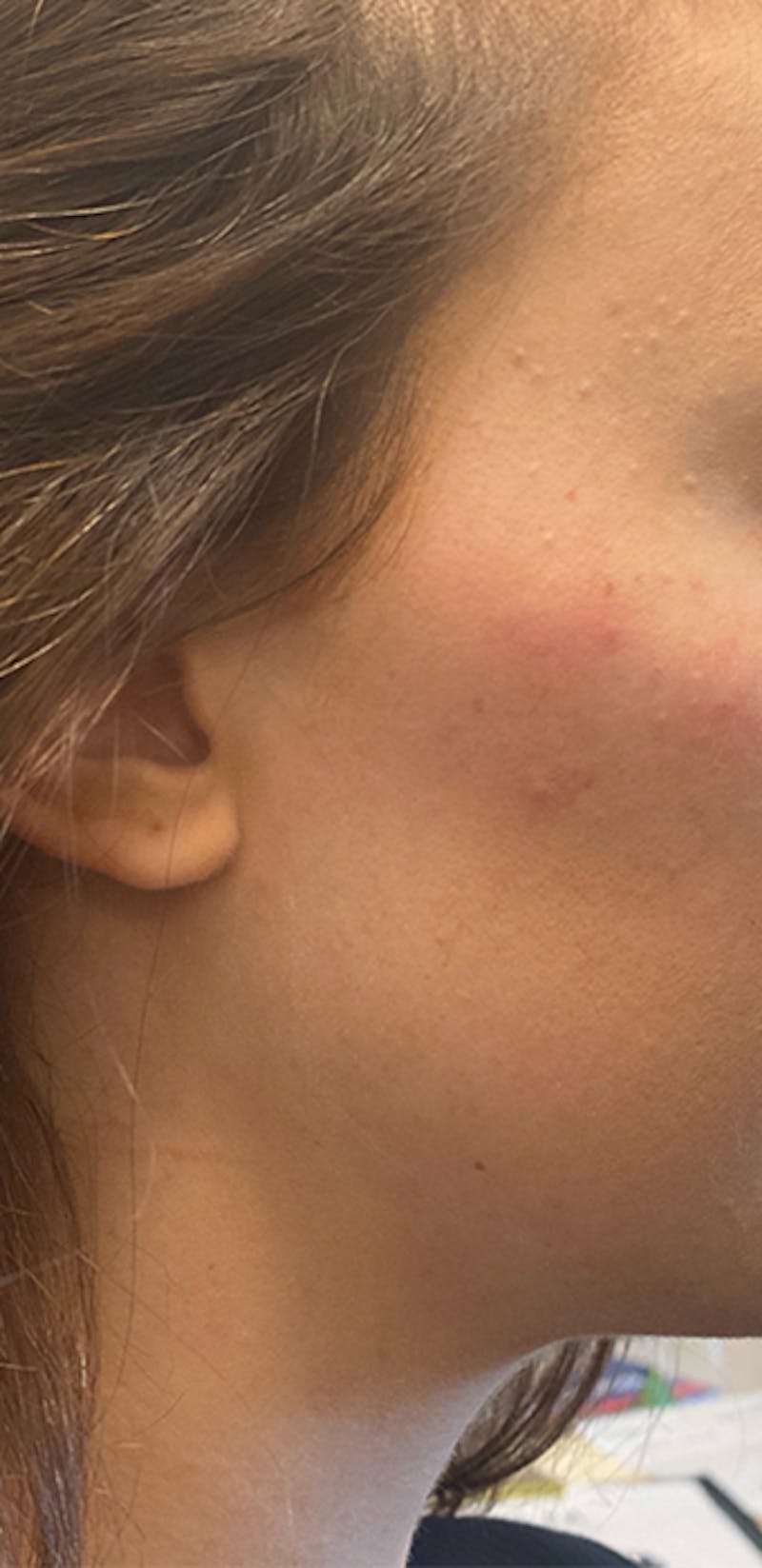 Filler Before & After Gallery - Patient 87569220 - Image 1