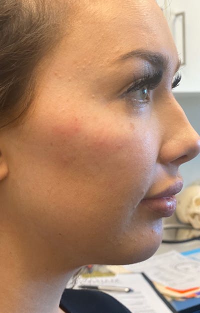 Filler Before & After Gallery - Patient 87586414 - Image 1