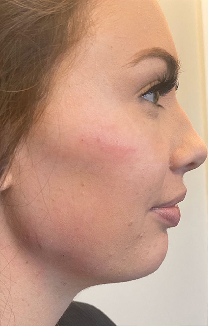 Filler Before & After Gallery - Patient 87586414 - Image 2