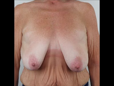 Breast Lift Before & After Gallery - Patient 87586428 - Image 1