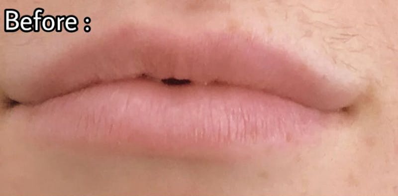 Filler Before & After Gallery - Patient 87586415 - Image 1