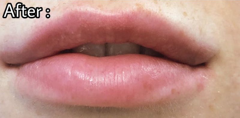 Filler Before & After Gallery - Patient 87586415 - Image 2