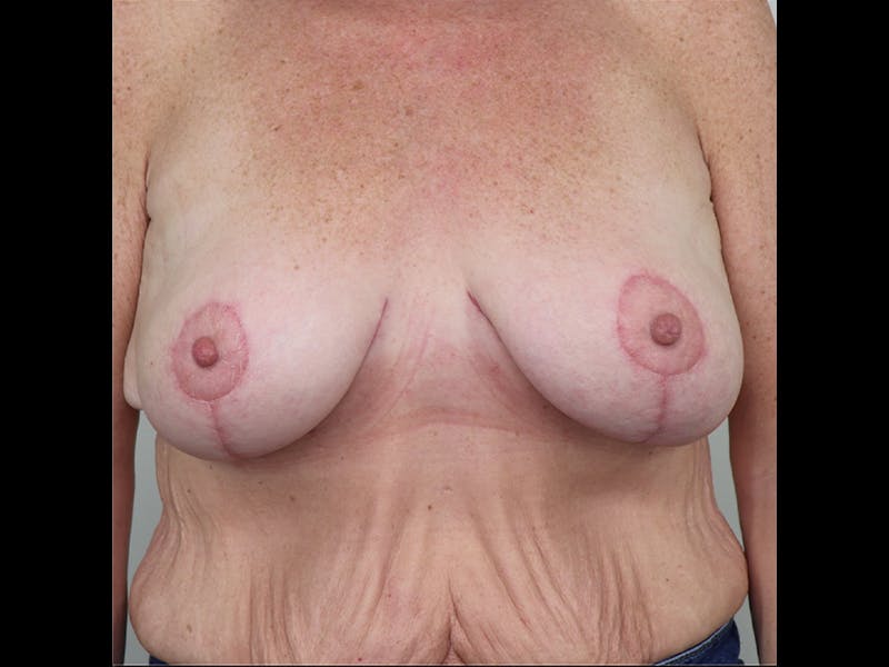 Breast Lift Before & After Gallery - Patient 87586428 - Image 2