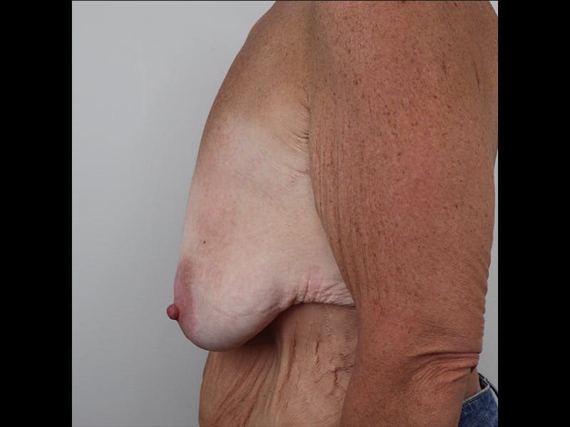 Breast Lift Before & After Gallery - Patient 87586428 - Image 3