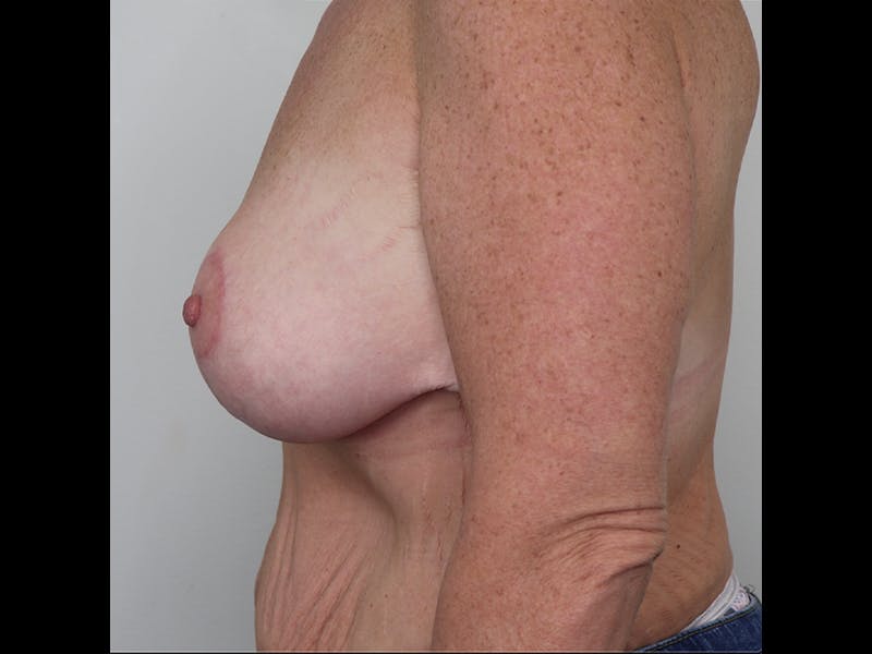 Breast Lift Before & After Gallery - Patient 87586428 - Image 4