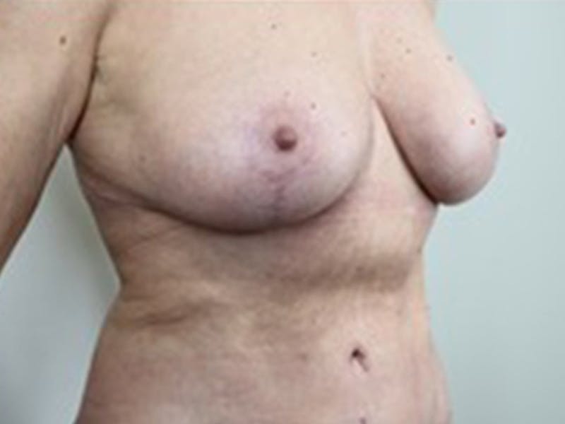 Breast Lift Before & After Gallery - Patient 87629802 - Image 2