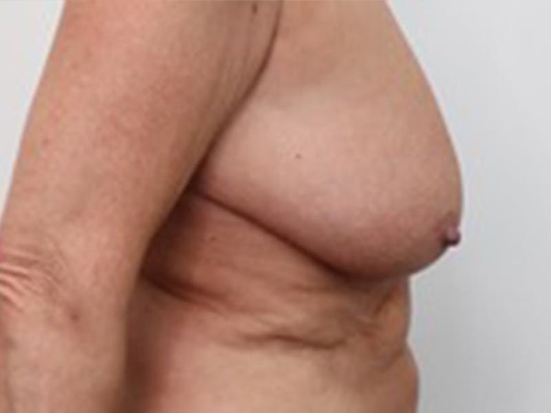 Breast Lift Before & After Gallery - Patient 87629802 - Image 3