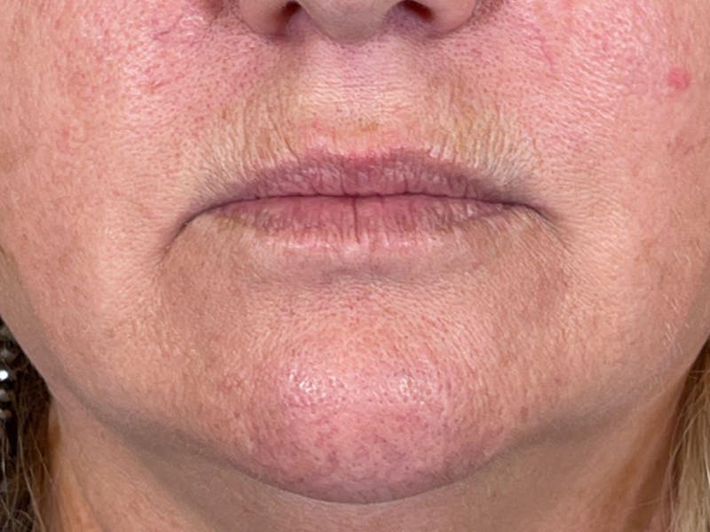 Filler Before & After Gallery - Patient 87631434 - Image 1