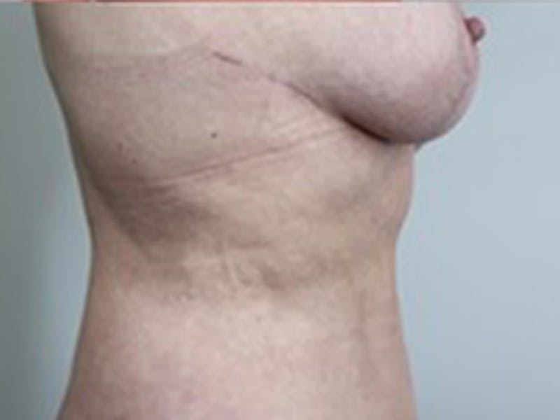 Breast Lift Before & After Gallery - Patient 87629802 - Image 4