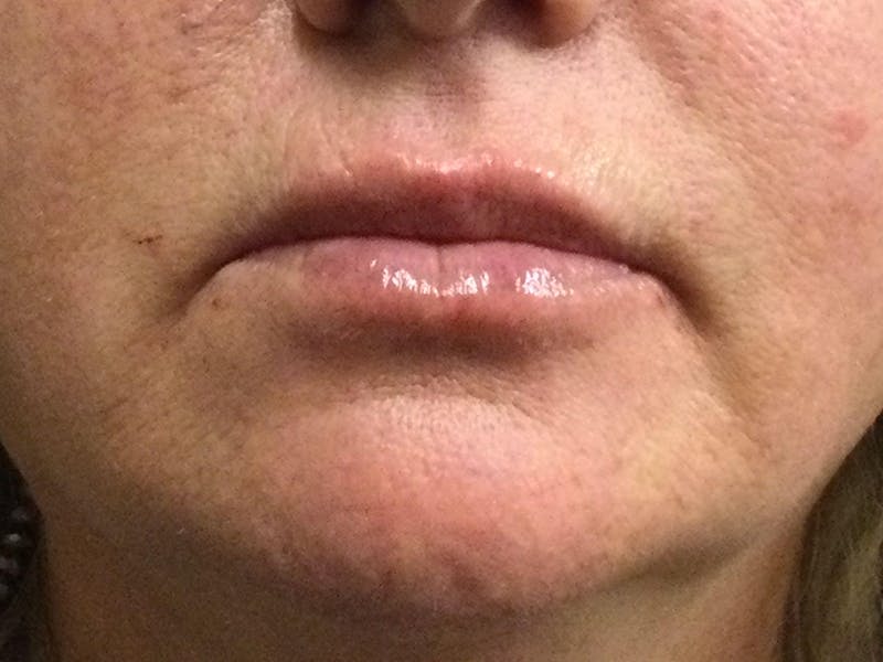 Filler Before & After Gallery - Patient 87631434 - Image 2